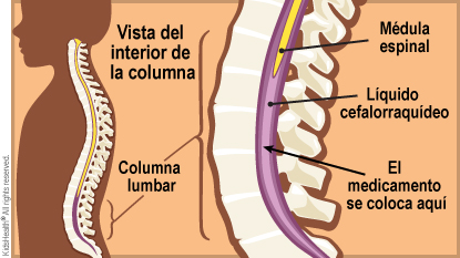 Se muestra una vista lateral de los huesos de la columna de un niño pequeño. También se muestra un primer plano de los huesos de la columna vertebral, la médula espinal y el espacio debajo de la médula espinal. Se indica el lugar donde se colocará el medicamento.